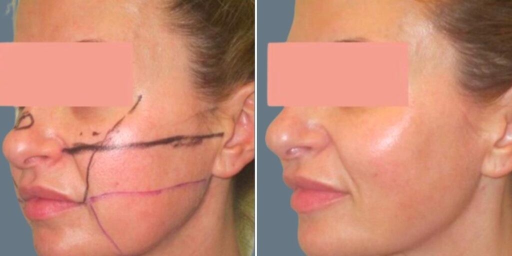 Face Chubby Cheeks Female Pre2024 013 Before And After