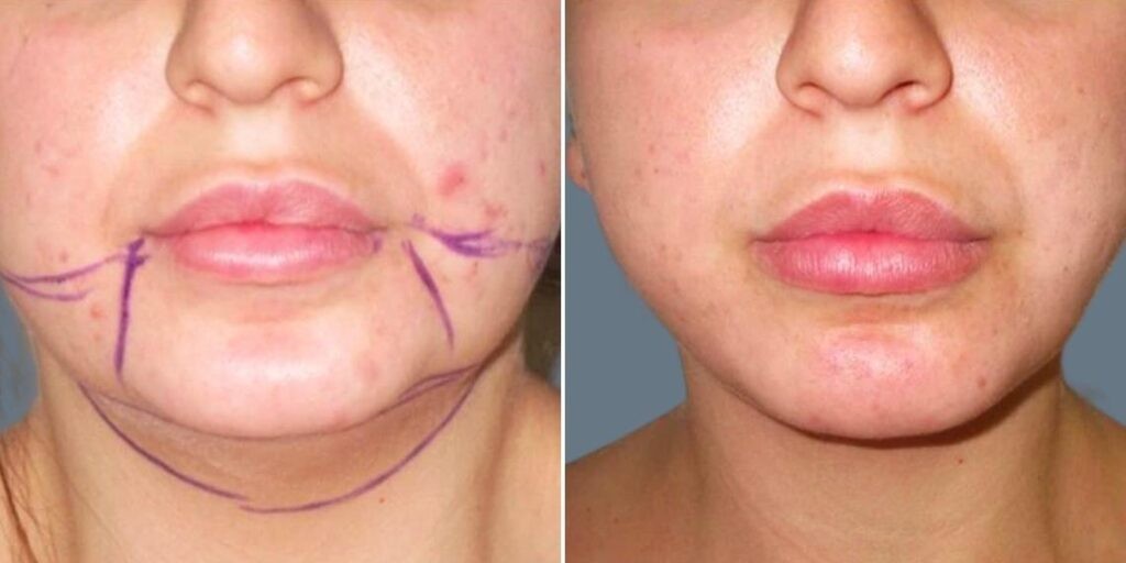 Face Chubby Cheeks Female Pre2024 015 Before And After