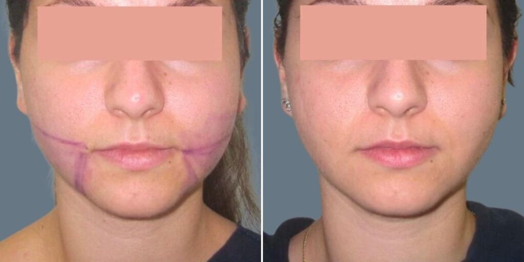 Face Chubby Cheeks Female Pre2024 016 Before And After