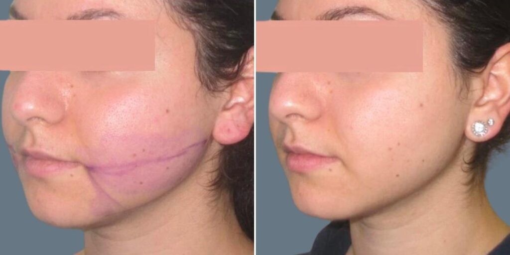 Face Chubby Cheeks Female Pre2024 017 Before And After