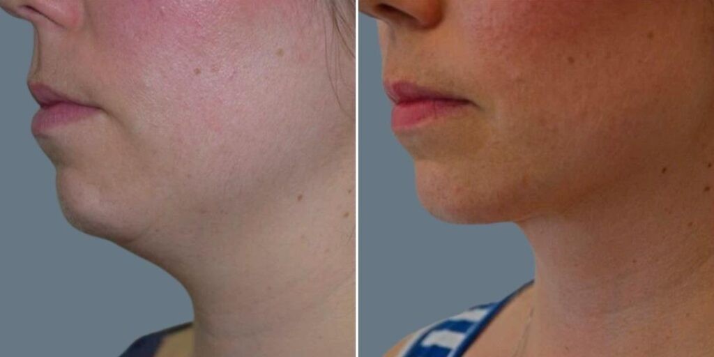 Face Chubby Cheeks Female Pre2024 020 Before And After