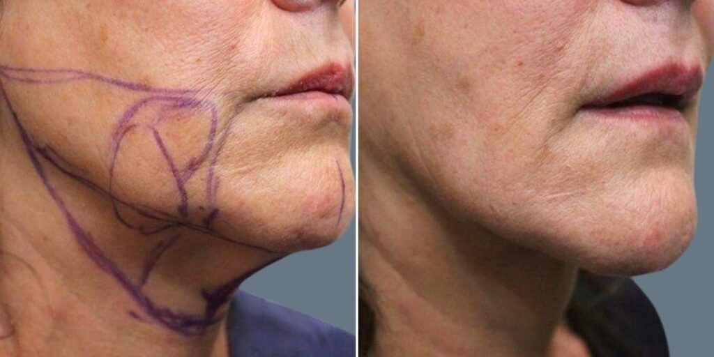 Face Chubby Cheeks Female Pre2024 021 Before And After