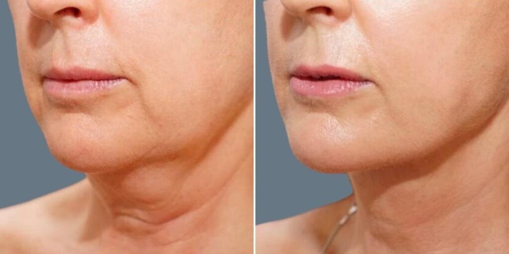 Face Chubby Cheeks Female Pre2024 022 Before And After