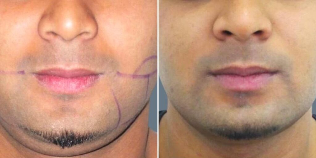 Face Chubby Cheeks Male Pre2024 014 Before And After