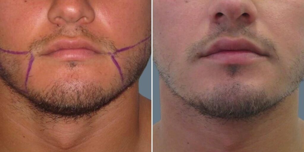 Face Chubby Cheeks Male Pre2024 018 Before And After