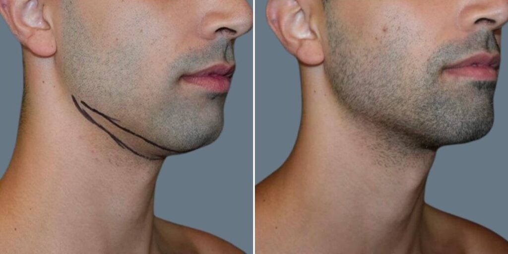 Face Chubby Cheeks Male Pre2024 019 Before And After