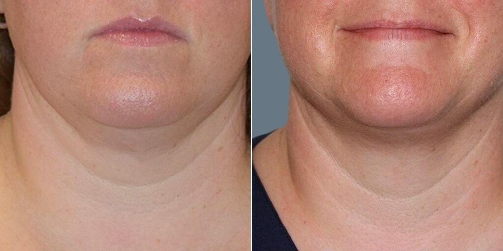 Face Fat Dissolving Injections Female Pre2024 002 Before And After