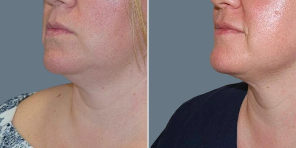Face Fat Dissolving Injections Female Pre2024 003 Before And After