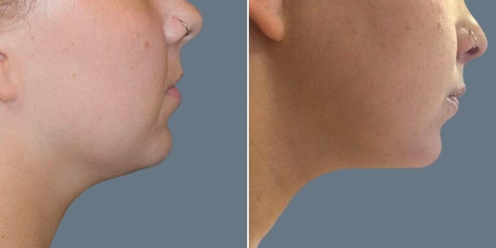 Face Fat Dissolving Injections Female Pre2024 004 Before And After