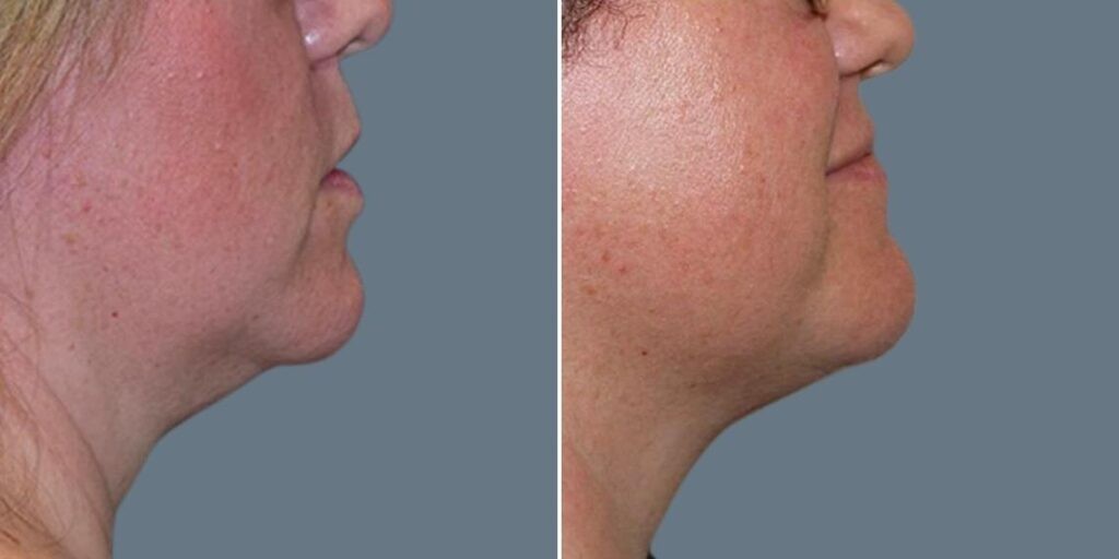 Face Fat Dissolving Injections Female Pre2024 005 Before And After