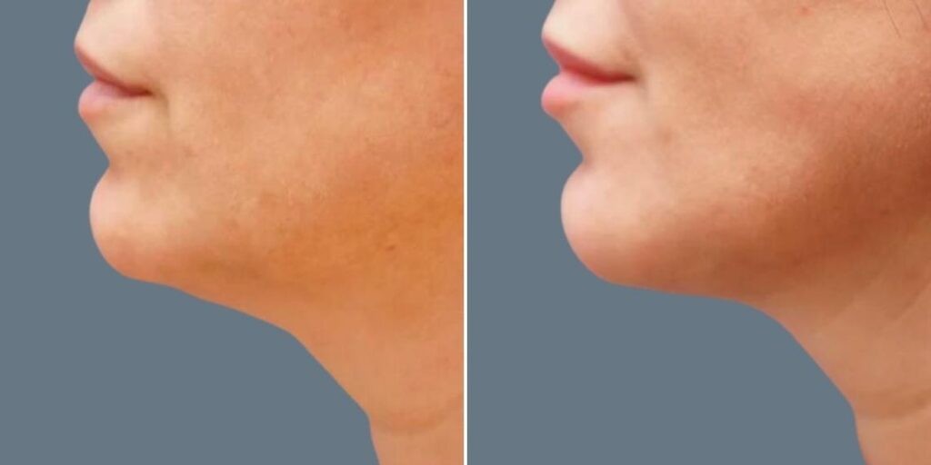 Face Fat Dissolving Injections Female Pre2024 006 Before And After