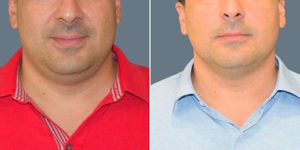 Face Fat Dissolving Injections Male Pre2024 001 Before And After