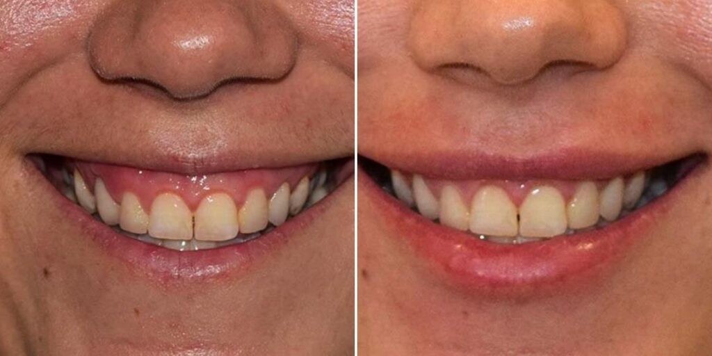 Face Gummy Smile Female Pre2024 001 Before And After