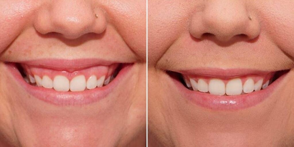 Face Gummy Smile Female Pre2024 002 Before And After