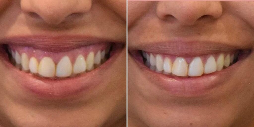 Face Gummy Smile Female Pre2024 003 Before And After