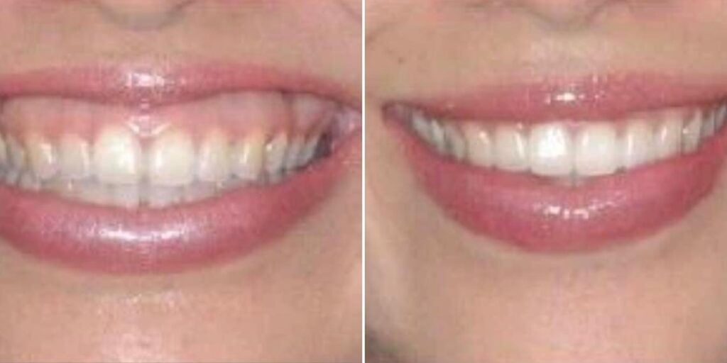 Face Gummy Smile Female Pre2024 004 Before And After