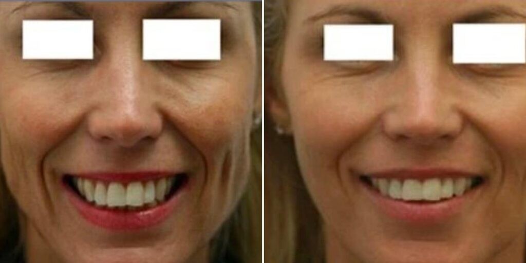 Face Jaw Line Contouring Female Pre2024 001  Before And After