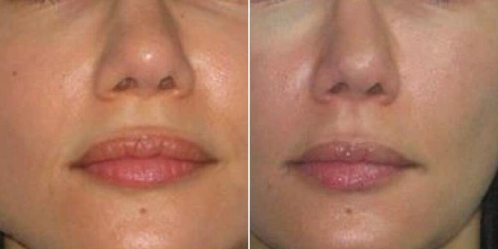 Face Jaw Line Contouring Female Pre2024 002 Before And After