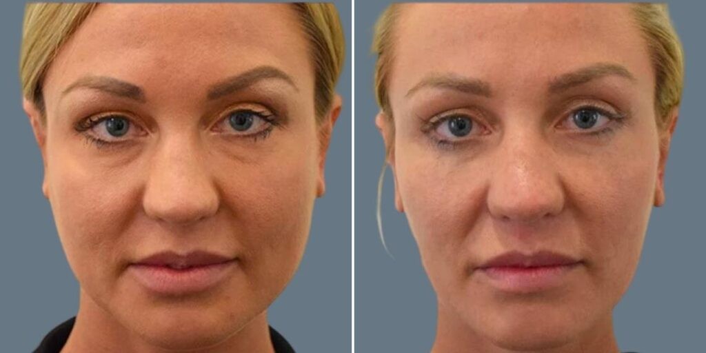 Face Jaw Line Contouring Female Pre2024 003 Before And After