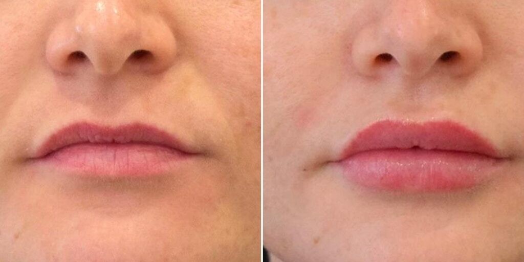 Face Lip Enhancement Female Pre2024 001 Before And After
