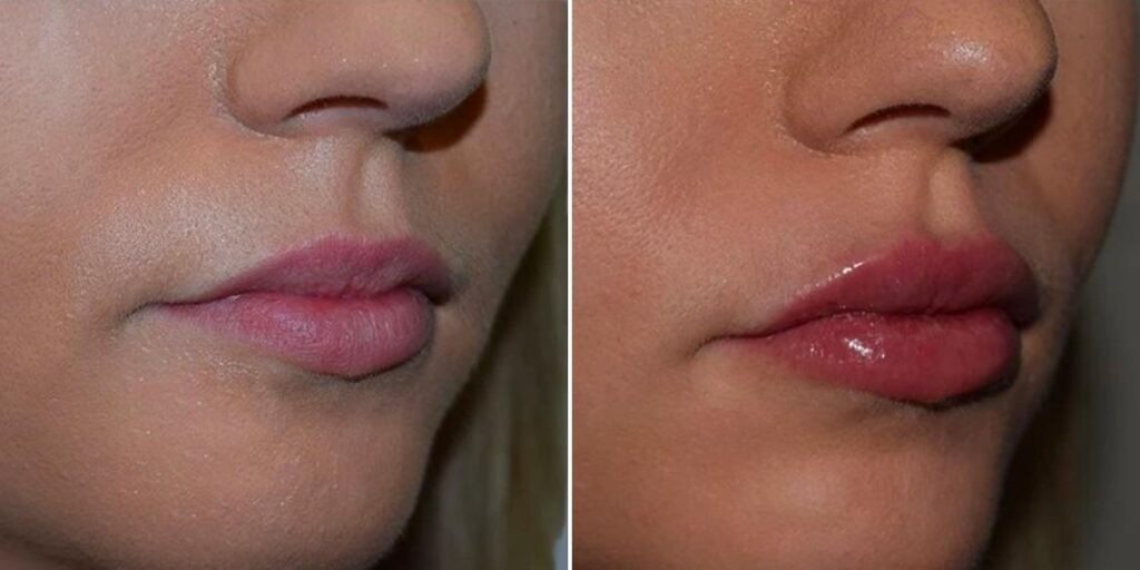 Face Lip Enhancement Female Pre2024 002 Before And After