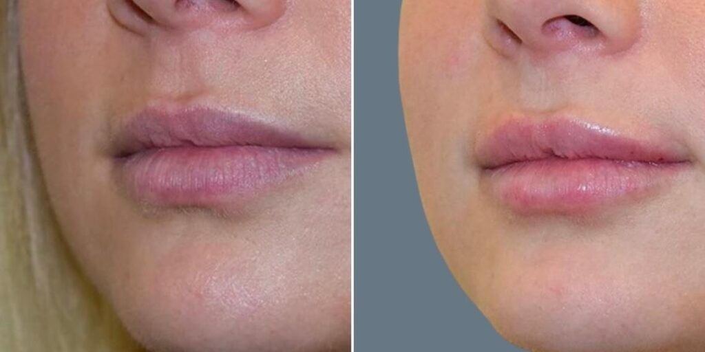 Face Lip Enhancement Female Pre2024 003 Before And After
