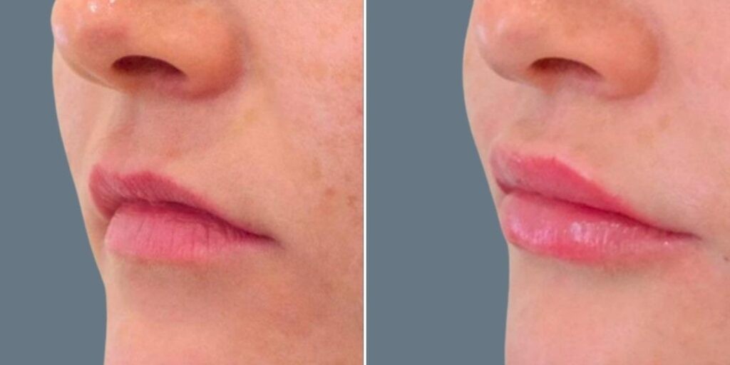 Face Lip Enhancement Female Pre2024 004 Before And After