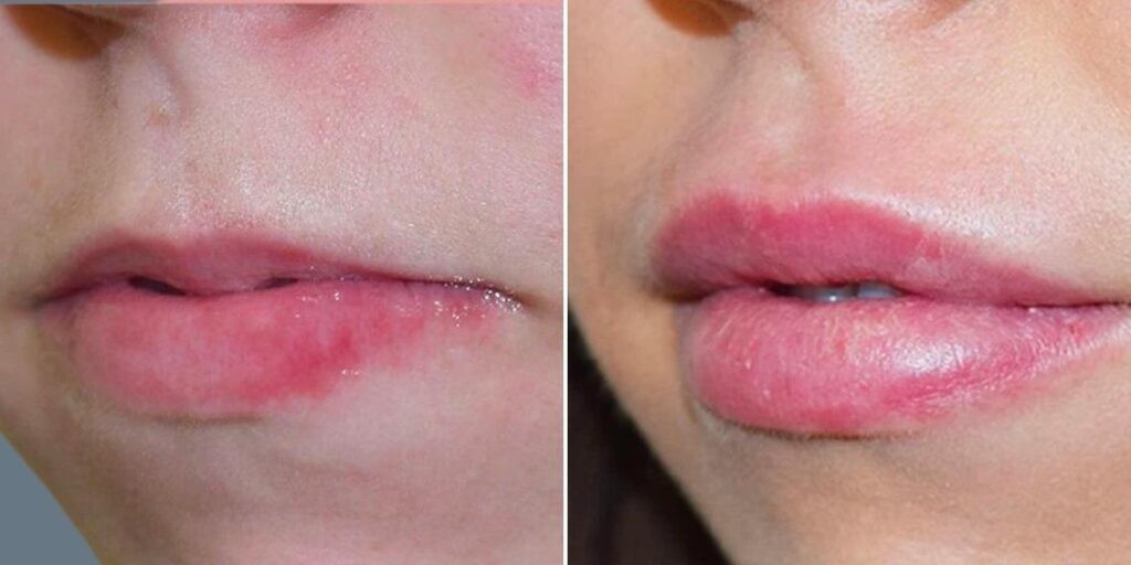 Face Lip Enhancement Female Pre2024 005 Before And After