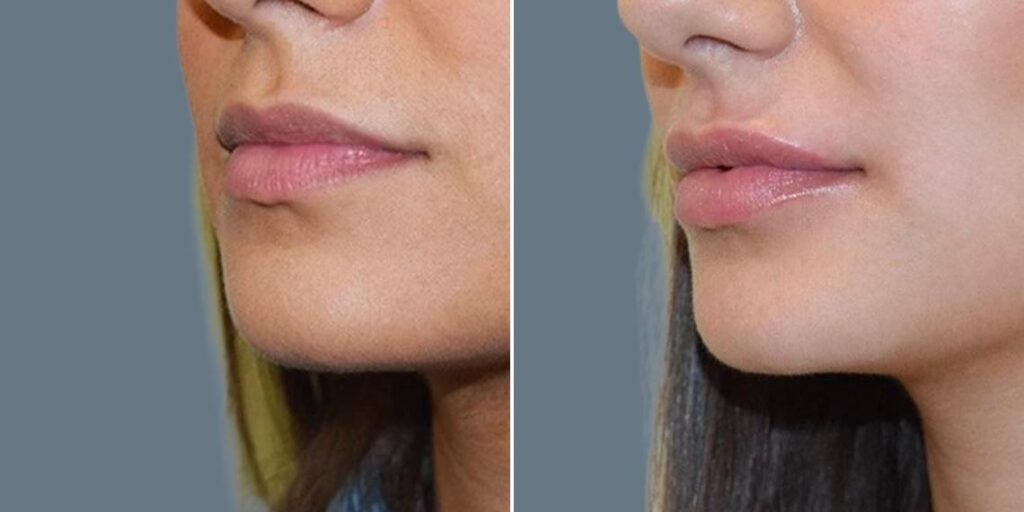 Face Lip Enhancement Female Pre2024 006 Before And After