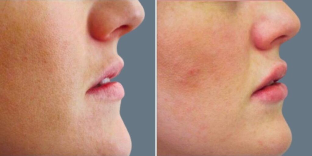 Face Lip Enhancement Female Pre2024 007 Before And After