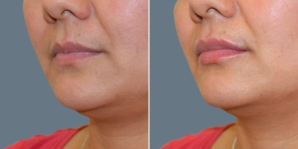 Face Lip Enhancement Female Pre2024 008 Before And After