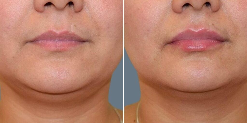 Face Lip Enhancement Female Pre2024 009 Before And After