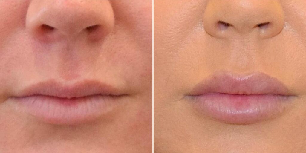 Face Lip Enhancement Female Pre2024 010 Before And After