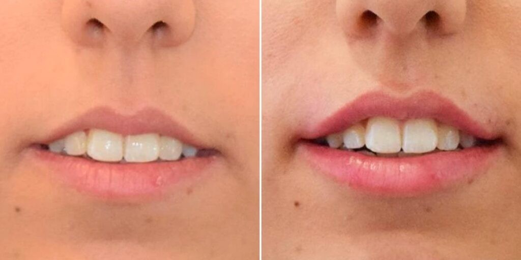 Face Lip Enhancement Female Pre2024 011 Before And After
