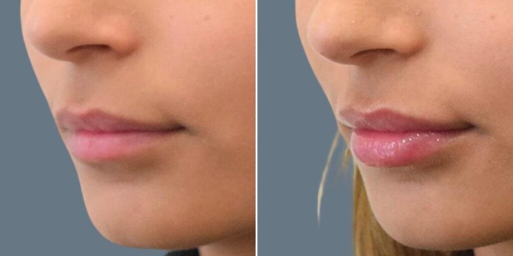 Face Lip Enhancement Female Pre2024 012 Before And After