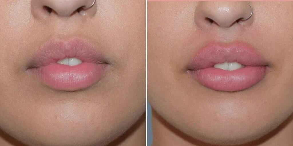 Face Lip Enhancement Female Pre2024 013 Before And After