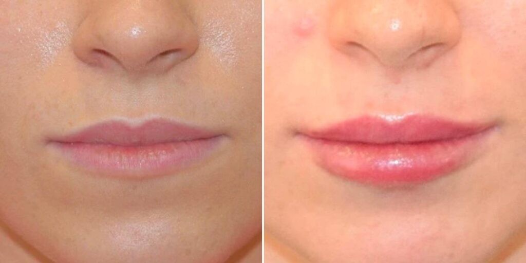 Face Lip Enhancement Female Pre2024 014 Before And After