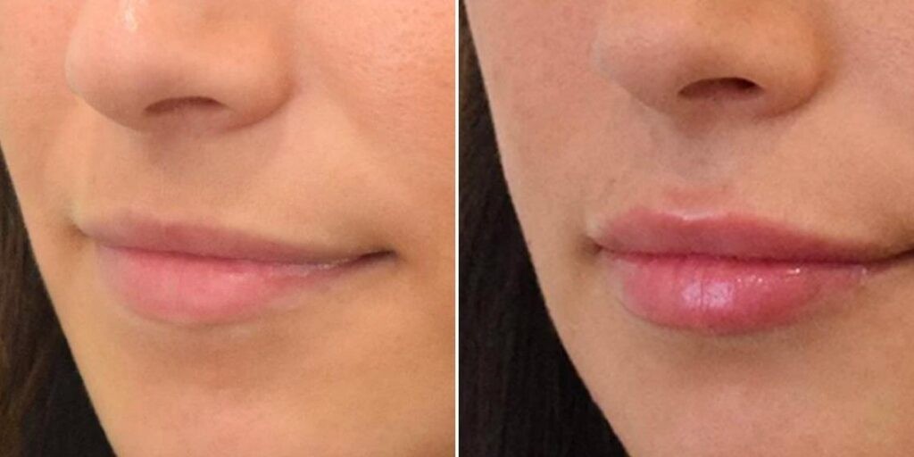 Face Lip Enhancement Female Pre2024 015 Before And After