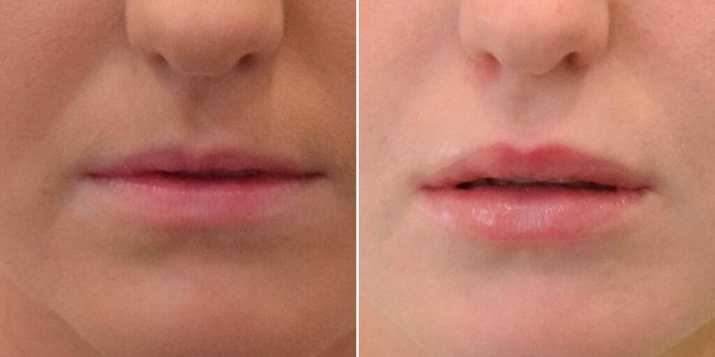 Face Lip Enhancement Female Pre2024 016 Before And After