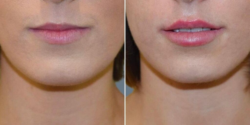 Face Lip Enhancement Female Pre2024 017 Before And After
