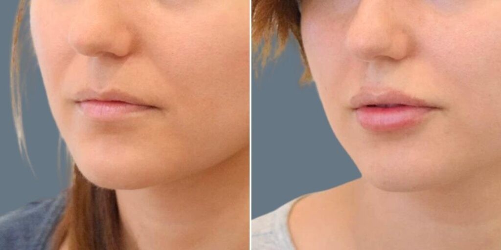 Face Lip Enhancement Female Pre2024 019 Before And After