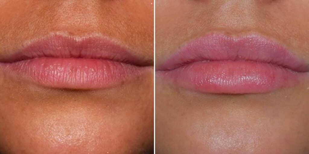 Face Lip Enhancement Female Pre2024 020 Before And After