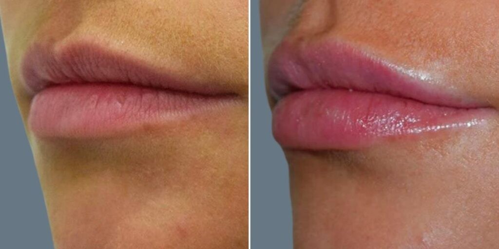 Face Lip Enhancement Female Pre2024 021 Before And After