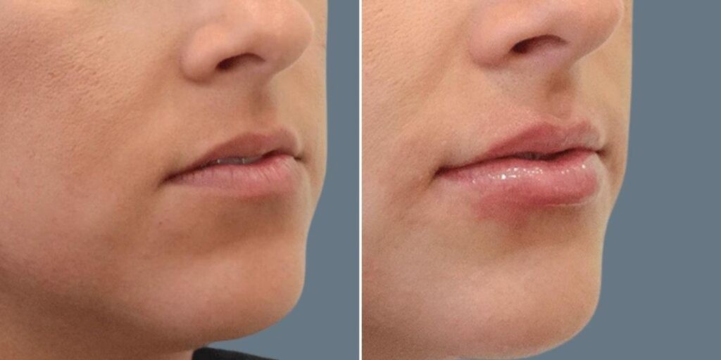Face Lip Enhancement Female Pre2024 022 Before And After