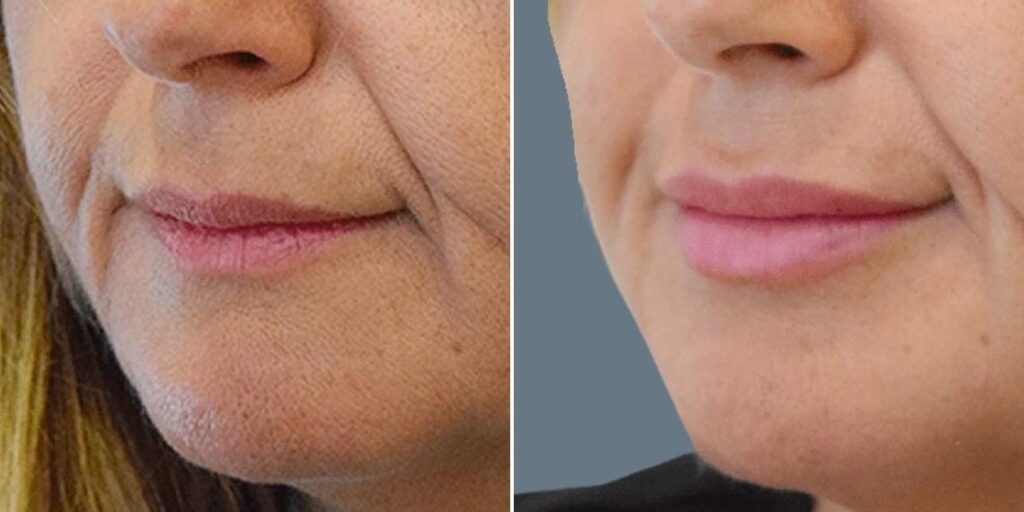 Face Lip Enhancement Female Pre2024 023 Before And After