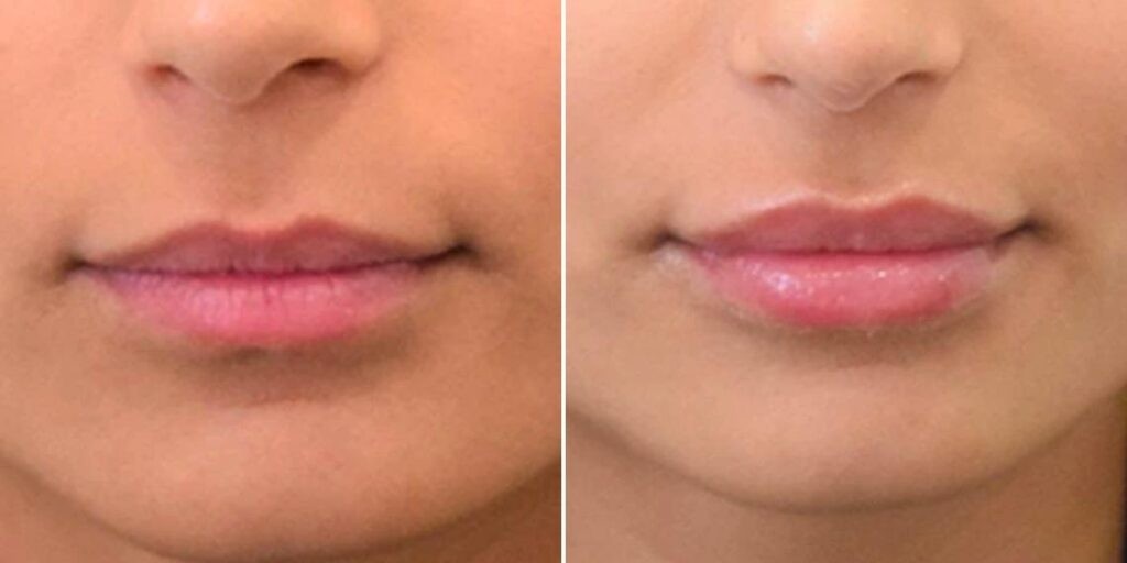 Face Lip Enhancement Female Pre2024 024 Before And After