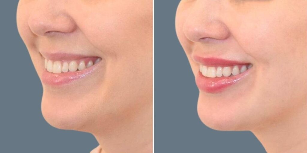 Face Lip Enhancement Female Pre2024 025 Before And After