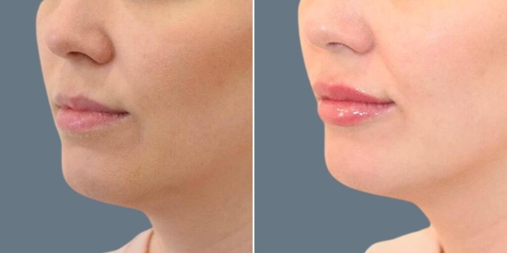 Face Lip Enhancement Female Pre2024 026 Before And After