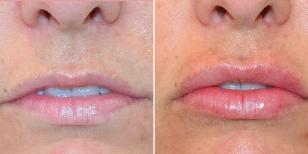 Face Lip Enhancement Female Pre2024 027 Before And After