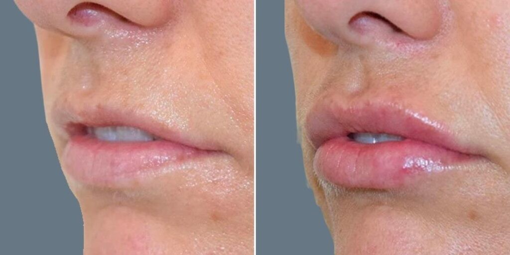 Face Lip Enhancement Female Pre2024 028 Before And After